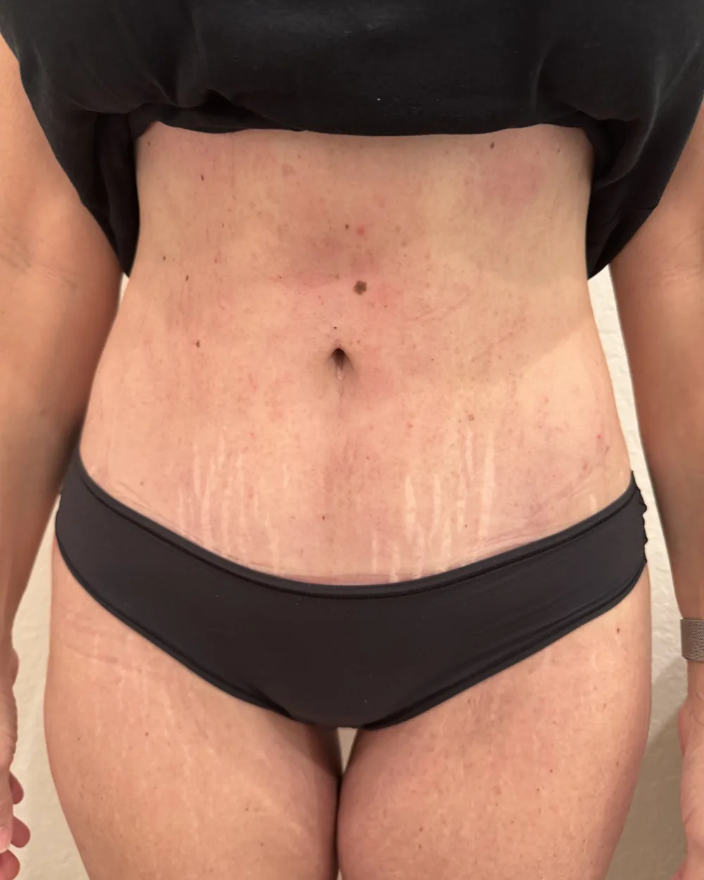 Later progress during post-operative recovery care at Reviv Spa, front view