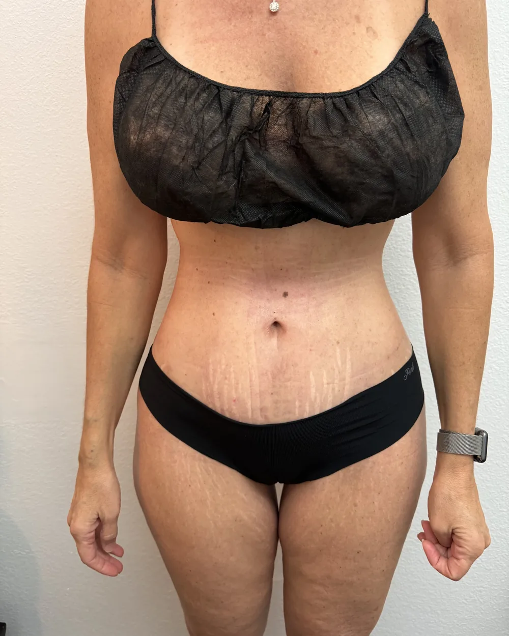 Before post-operative recovery care at Reviv Spa, front view