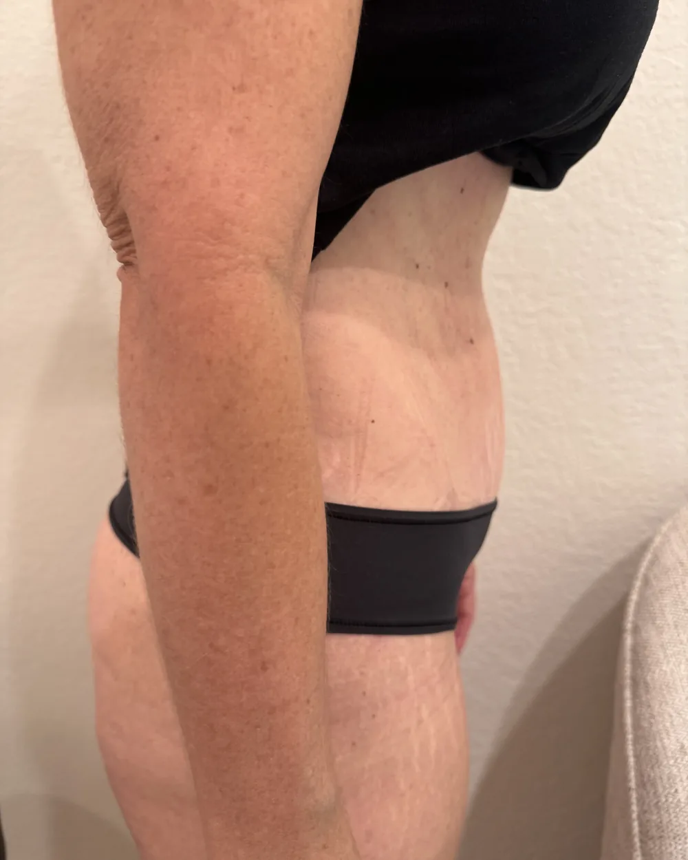 Later progress during post-operative abdominal recovery care at Reviv Spa, profile view