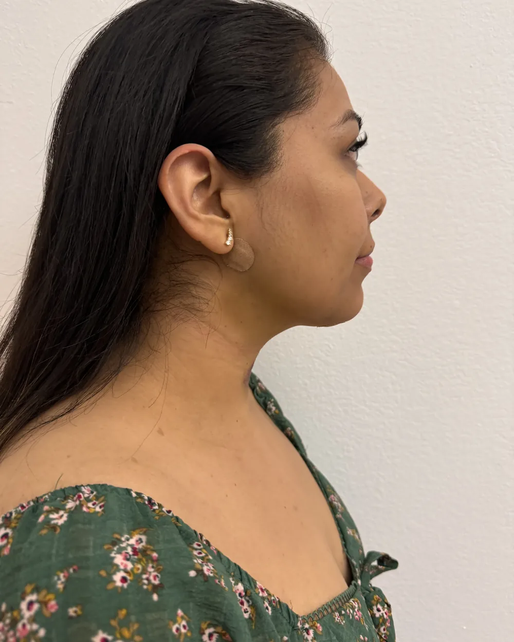 Before chin lipo recovery care at Reviv Spa, profile view